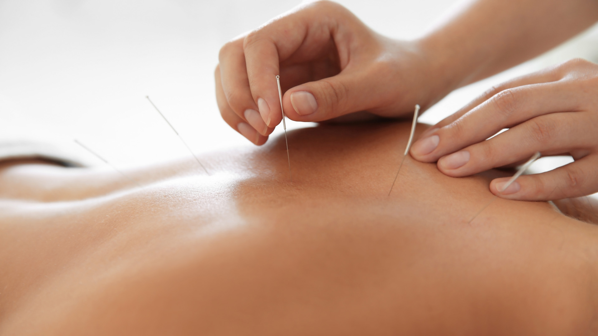 Acupuncture